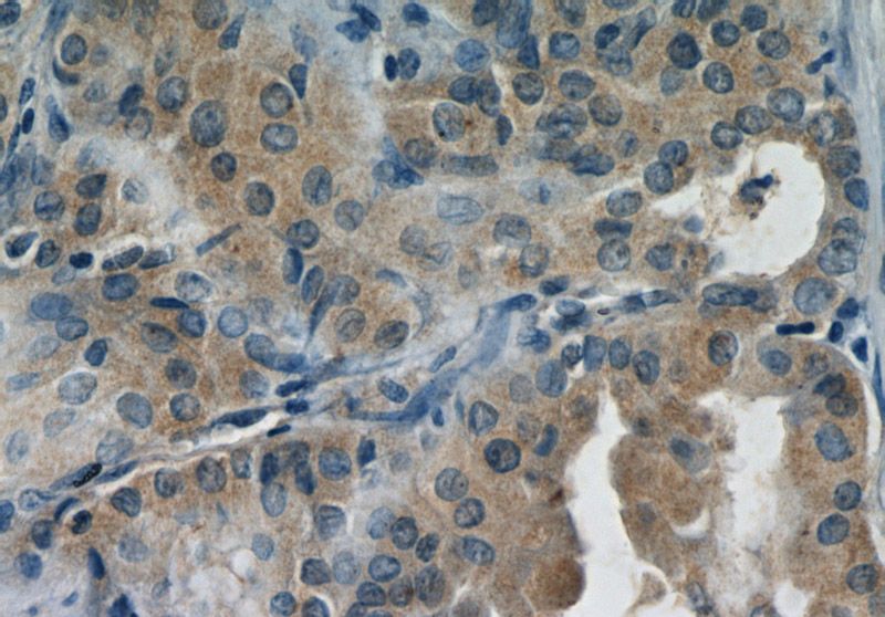 Immunohistochemistry of paraffin-embedded human thyroid cancer slide using Catalog No:109891(DEPDC6 Antibody) at dilution of 1:50