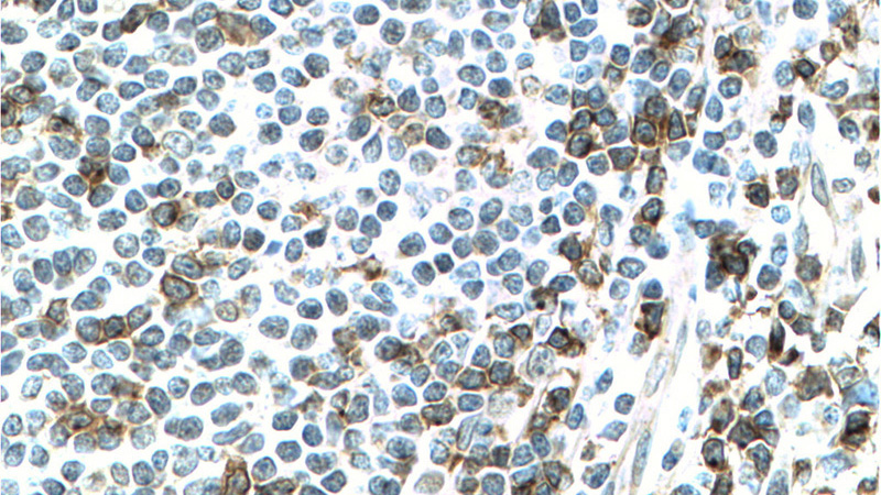 Immunohistochemistry of paraffin-embedded human tonsillitis tissue slide using Catalog No:109064(CD2 Antibody) at dilution of 1:200 (under 40x lens). Heat mediated antigen retrieved with Tris-EDTA buffer, pH9.0