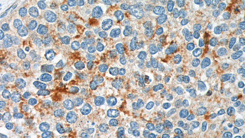 Immunohistochemistry of paraffin-embedded human cervical cancer tissue slide using Catalog No:115146(SFRP4 Antibody) at dilution of 1:200 (under 40x lens).