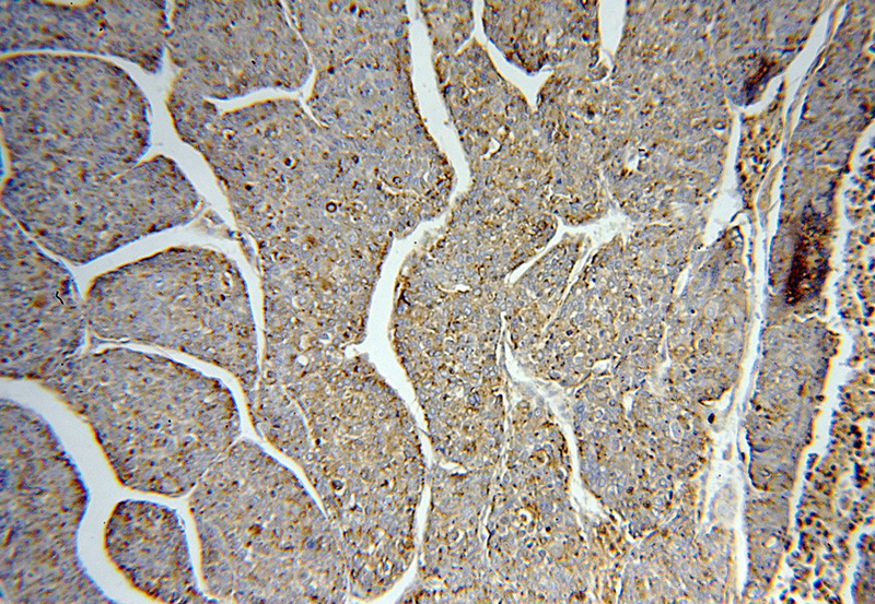 Immunohistochemical of paraffin-embedded human liver cancer using Catalog No:114291(PSAP antibody) at dilution of 1:100 (under 10x lens)