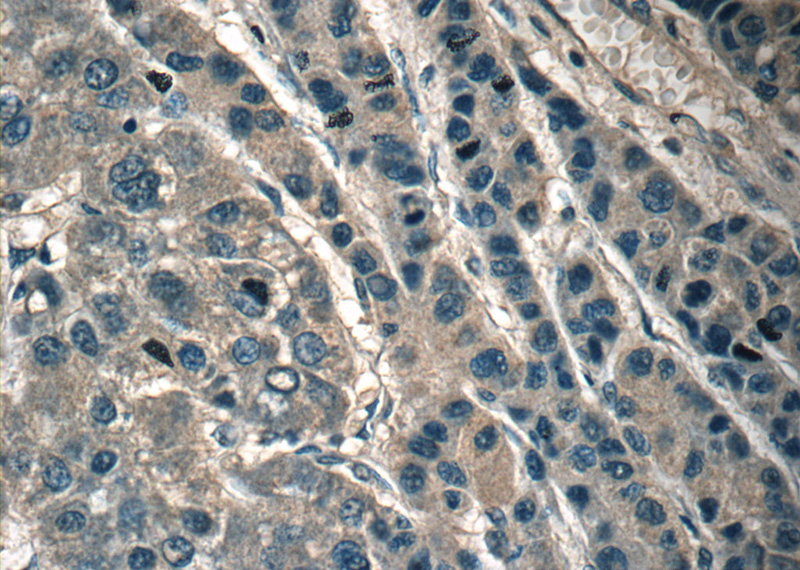 Immunohistochemistry of paraffin-embedded human liver cancer tissue slide using Catalog No:114886(RPL29 Antibody) at dilution of 1:50 (under 40x lens)