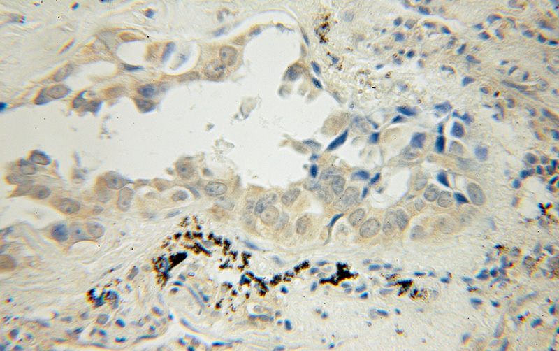Immunohistochemical of paraffin-embedded human lung cancer using Catalog No:116473(UBAP1 antibody) at dilution of 1:50 (under 10x lens)