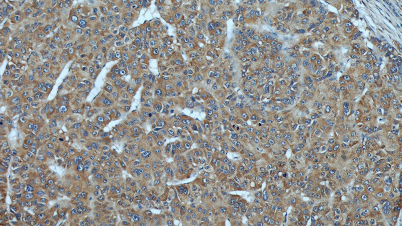 Immunohistochemical of paraffin-embedded human liver cancer using Catalog No:109892(DEPDC6 antibody) at dilution of 1:50 (under 10x lens)