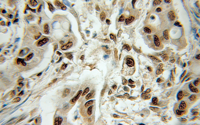 Immunohistochemical of paraffin-embedded human colon cancer using Catalog No:113334(OGFR antibody) at dilution of 1:100 (under 10x lens)