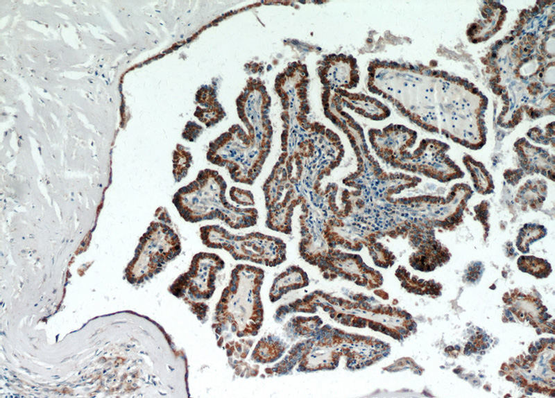 Immunohistochemical of paraffin-embedded human thyroid cancer using Catalog No:110294(ECM1 antibody) at dilution of 1:100 (under 10x lens)
