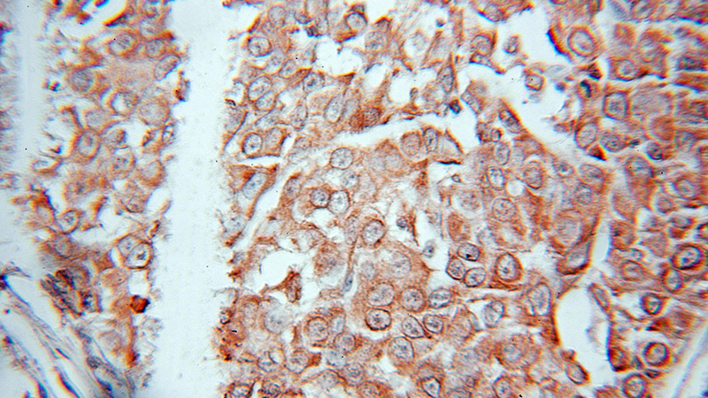 Immunohistochemical of paraffin-embedded human breast cancer using Catalog No:110315(EEF1E1 antibody) at dilution of 1:10 (under 10x lens)