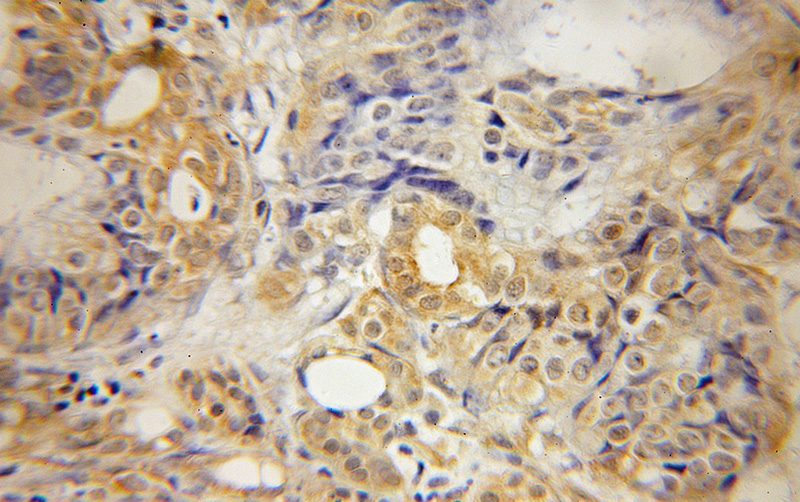 Immunohistochemical of paraffin-embedded human pancreas cancer using Catalog No:115114(SEPT10 antibody) at dilution of 1:50 (under 10x lens)