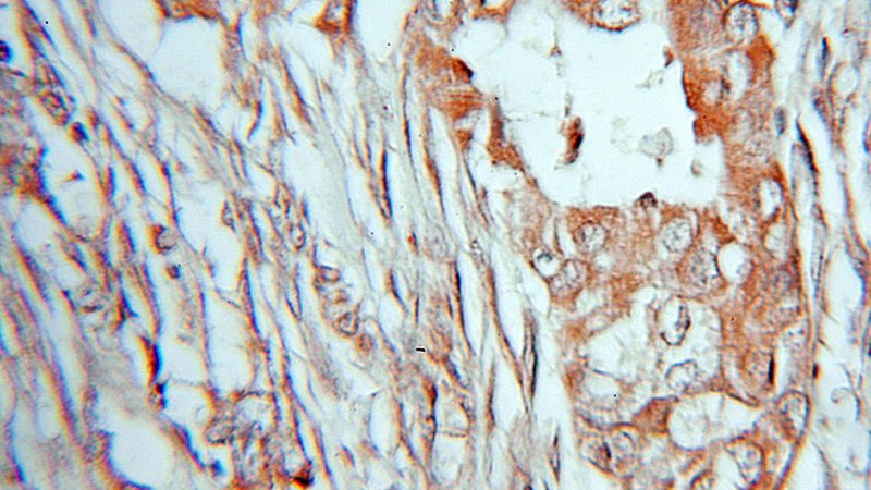 Immunohistochemical of paraffin-embedded human lung cancer using Catalog No:113570(PANK2 antibody) at dilution of 1:10 (under 10x lens)