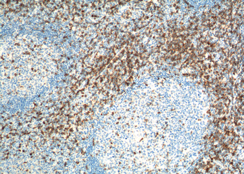 Immunohistochemistry of paraffin-embedded human tonsillitis tissue slide using Catalog No:109136(CD7 Antibody) at dilution of 1:200 (under 10x lens). heat mediated antigen retrieved with Tris-EDTA buffer(pH9).