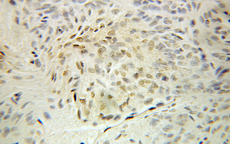 Immunohistochemical of paraffin-embedded human ovary tumor using Catalog No:116297(TRIM11 antibody) at dilution of 1:100 (under 10x lens)