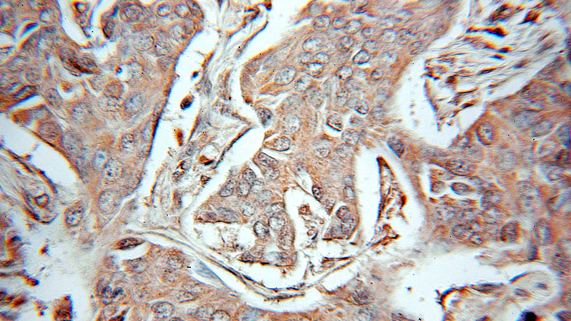 Immunohistochemical of paraffin-embedded human breast cancer using Catalog No:115665(SRC antibody) at dilution of 1:10 (under 10x lens)