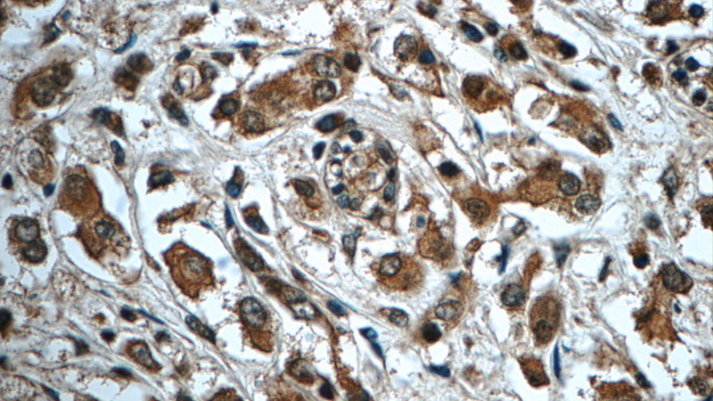 Immunohistochemistry of paraffin-embedded human breast cancer tissue slide using Catalog No:115802(SDCBP2 Antibody) at dilution of 1:50 (under 40x lens)