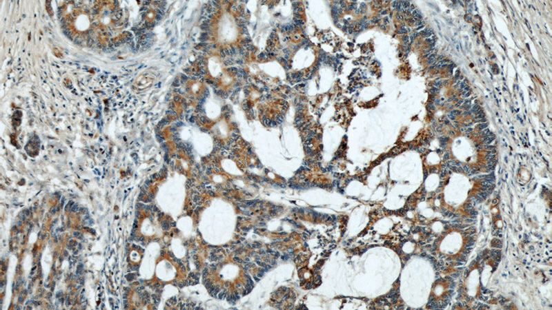 Immunohistochemical of paraffin-embedded human colon cancer using Catalog No:117297(Tubulin-Alpha antibody) at dilution of 1:50 (under 10x lens)