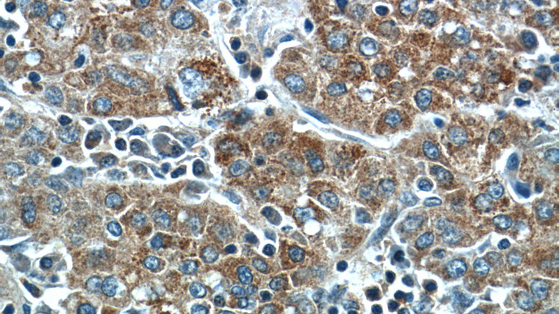 Immunohistochemistry of paraffin-embedded human liver cancer tissue slide using Catalog No:116110(TMEM182 Antibody) at dilution of 1:50 (under 40x lens)