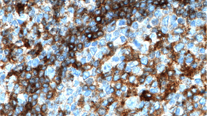 Immunohistochemistry of paraffin-embedded human tonsillitis tissue slide using Catalog No:111422(HLA-DQA1 Antibody) at dilution of 1:200 (under 40x lens). heat mediated antigen retrieved with Tris-EDTA buffer(pH9).