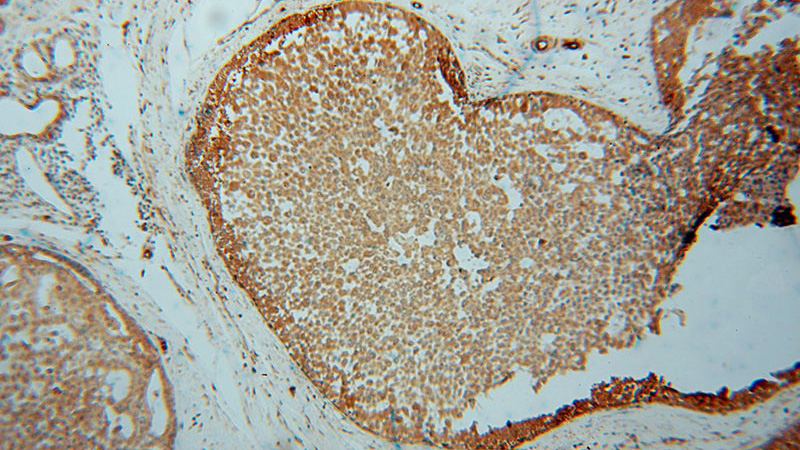 Immunohistochemical of paraffin-embedded human breast cancer using Catalog No:114077(PPA1 antibody) at dilution of 1:50 (under 10x lens)
