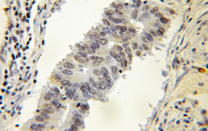 Immunohistochemical of paraffin-embedded human colon cancer using Catalog No:110101(DNAJC1 antibody) at dilution of 1:50 (under 10x lens)
