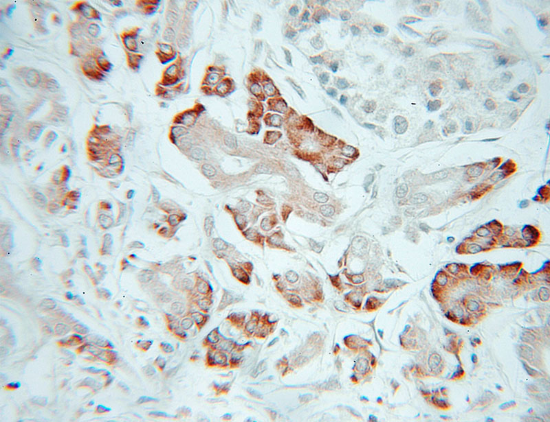 Immunohistochemical of paraffin-embedded human pancreas cancer using Catalog No:108184(ARHGEF16 antibody) at dilution of 1:50 (under 25x lens)