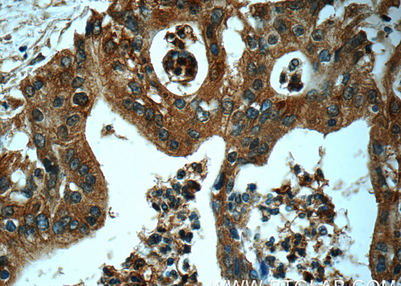 Immunohistochemistry of paraffin-embedded human pancreas cancer tissue slide using Catalog No:116692(USP9X Antibody) at dilution of 1:50 (under 40x lens)