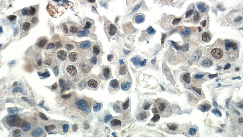 Immunohistochemical of paraffin-embedded human breast cancer using Catalog No:109730(CTR9 antibody) at dilution of 1:200 (under 40x lens)