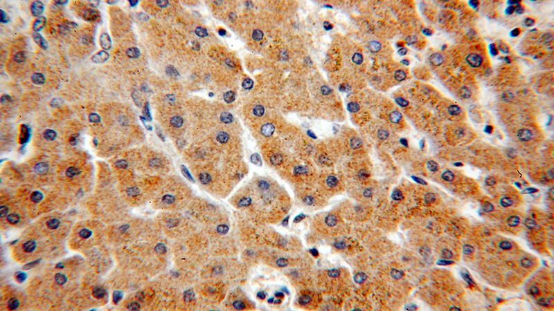 Immunohistochemical of paraffin-embedded human hepatocirrhosis using Catalog No:109706(CYP4F11-Specific antibody) at dilution of 1:50 (under 40x lens)