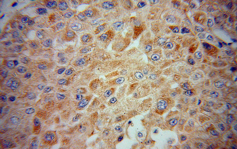 Immunohistochemical of paraffin-embedded human liver cancer using Catalog No:109696(CYP2J2 antibody) at dilution of 1:50 (under 40x lens)