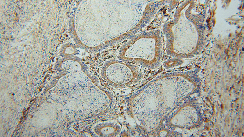 Immunohistochemical of paraffin-embedded human colon cancer using Catalog No:108307(ATP6V1B2 antibody) at dilution of 1:100 (under 10x lens)