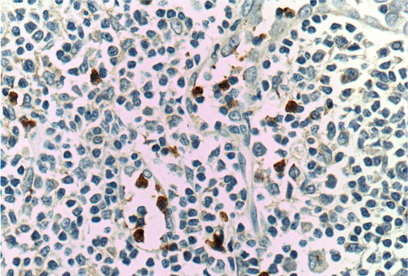 Immunohistochemistry of paraffin-embedded human tonsillitis tissue slide using Catalog No:112223(LILRA2 Antibody) at dilution of 1:200 (under 40x lens)