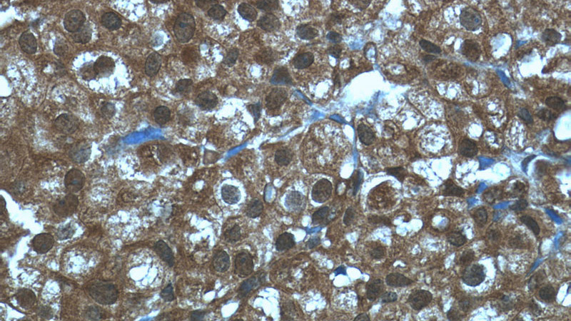 Immunohistochemistry of paraffin-embedded human breast cancer tissue slide using Catalog No:110201(EIF4A2 Antibody) at dilution of 1:50 (under 40x lens)