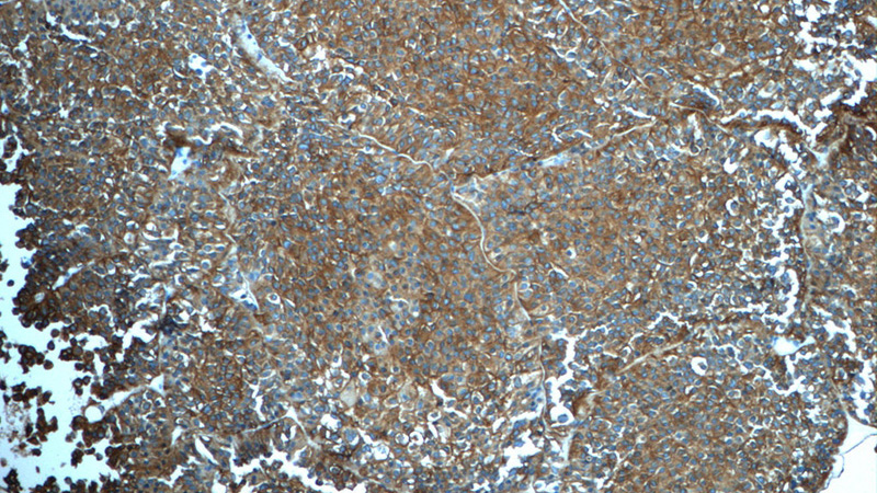 Immunohistochemistry of paraffin-embedded human pituitary adenoma tissue slide using Catalog No:115768(Synaptophysin; SYP Antibody) at dilution of 1:50 (under 10x lens)