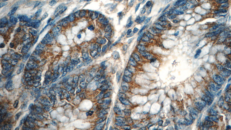 Immunohistochemistry of paraffin-embedded human colon tissue slide using Catalog No:116268(TPM3 Antibody) at dilution of 1:50 (under 40x lens)