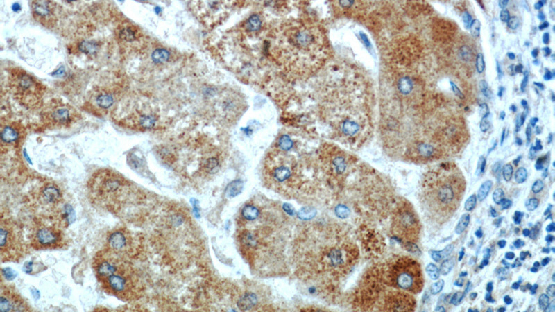 Immunohistochemical of paraffin-embedded human hepatocirrhosis using Catalog No:117013(ZNF622 antibody) at dilution of 1:100 (under 40x lens)