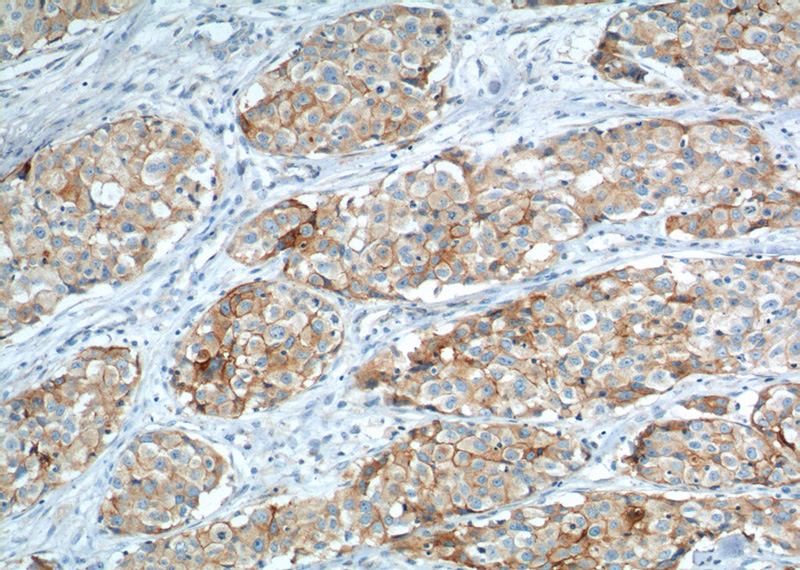 Immunohistochemistry of paraffin-embedded human lung cancer tissue slide using (VCAM-1 Antibody) at dilution of 1:800 (under 10x lens). heat mediated antigen retrieved with Tris-EDTA buffer(pH9).