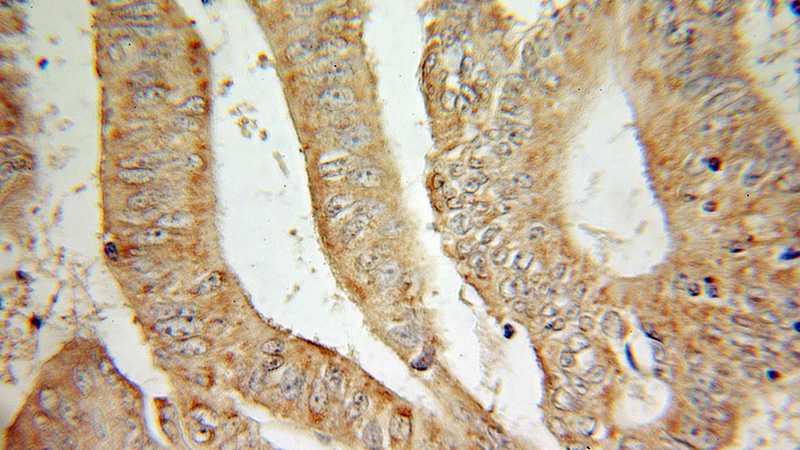 Immunohistochemical of paraffin-embedded human colon cancer using Catalog No:113189(NIPSNAP3A antibody) at dilution of 1:100 (under 10x lens)