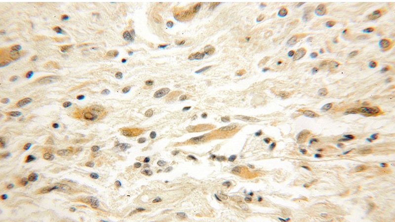 Immunohistochemical of paraffin-embedded human medulloblastoma using Catalog No:110210(EFHD2 antibody) at dilution of 1:50 (under 10x lens)