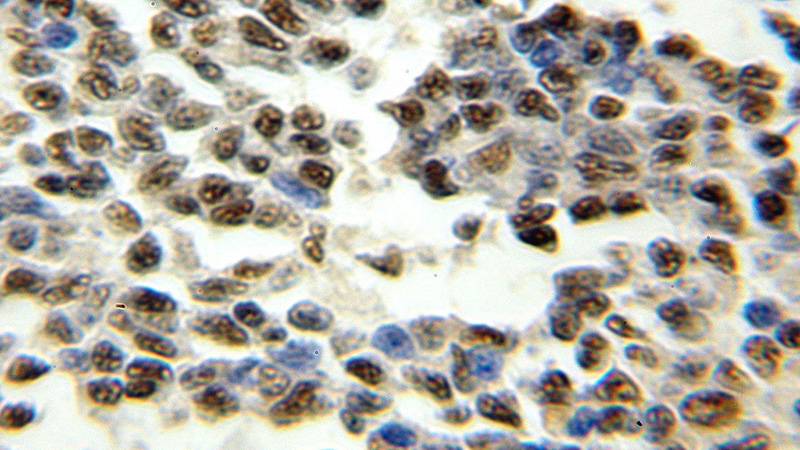 Immunohistochemical of paraffin-embedded human lymphoma using Catalog No:110879(GATA2 antibody) at dilution of 1:50 (under 10x lens)