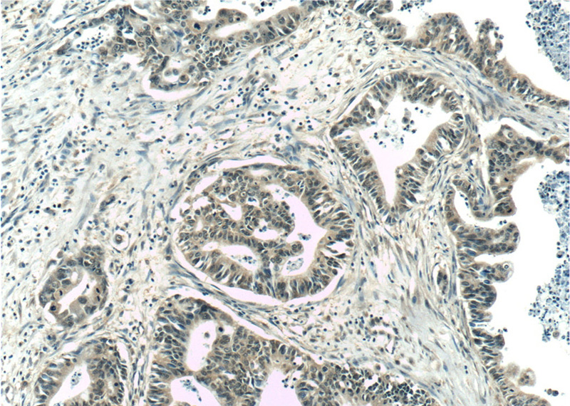 Immunohistochemistry of paraffin-embedded human pancreas cancer tissue slide using Catalog No:107307(GSNOR,ADH5 Antibody) at dilution of 1:50 (under 10x lens)