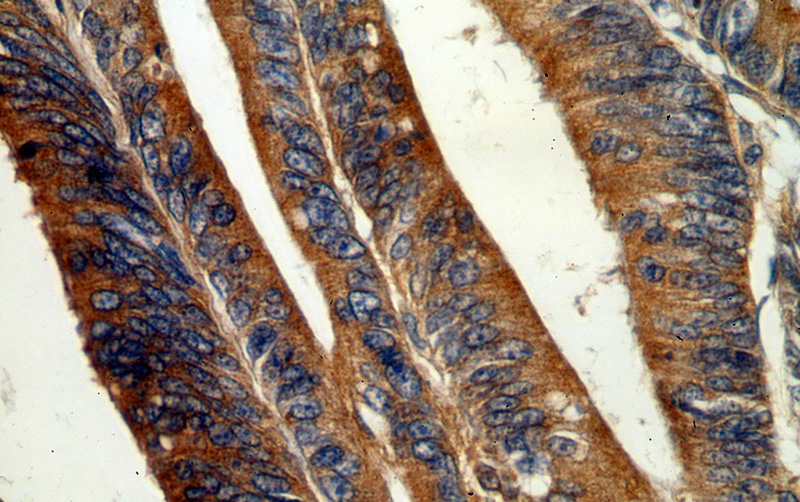 Immunohistochemical of paraffin-embedded human colon cancer using Catalog No:110819(GADD34 antibody) at dilution of 1:100 (under 40x lens)
