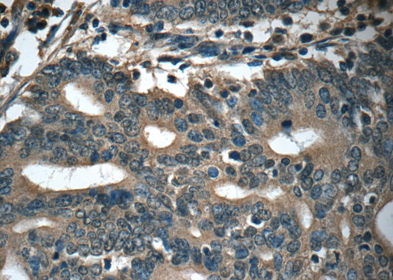 Immunohistochemistry of paraffin-embedded human endometrial cancer tissue slide using Catalog No:111665(IFT20 Antibody) at dilution of 1:50 (under 40x lens)