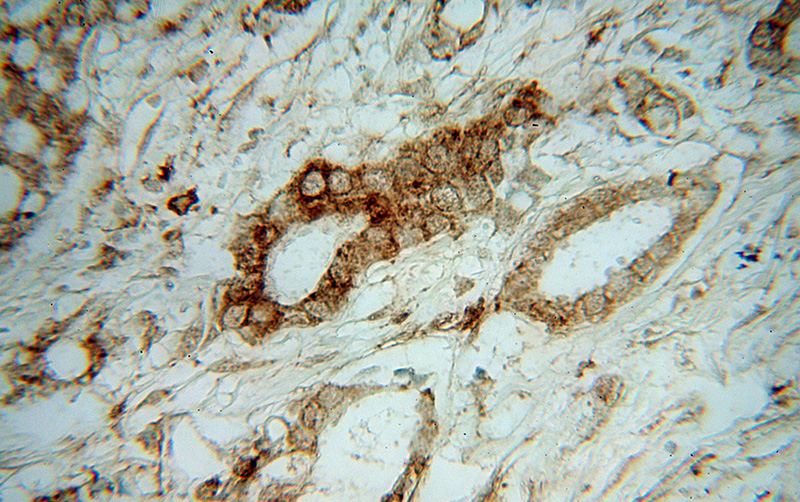 Immunohistochemical of paraffin-embedded human breast cancer using Catalog No:116451(ERP44 antibody) at dilution of 1:100 (under 40x lens)