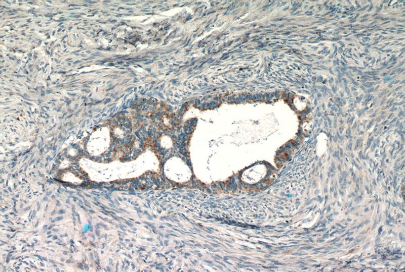Immunohistochemistry of paraffin-embedded human ovary tumor slide using Catalog No:114479(RASGRP3 Antibody) at dilution of 1:50