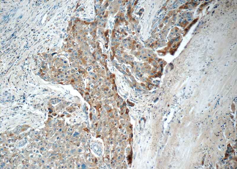 Immunohistochemistry of paraffin-embedded human liver cancer tissue slide using Catalog No:107372(LBP Antibody) at dilution of 1:50 (under 10x lens)