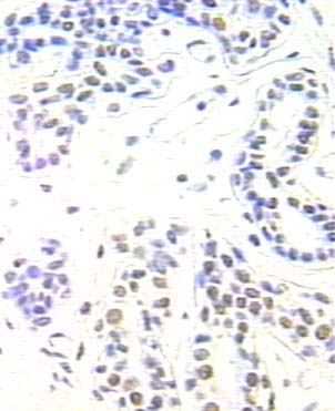 Immunohistochemical of paraffin-embedded human breast cancer using Catalog No:108137(APEX1 antibody) at dilution of 1:100 (under 25x lens)