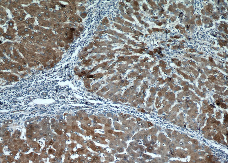 Immunohistochemical of paraffin-embedded human hepatocirrhosis using Catalog No:107975(ALDH8A1 antibody) at dilution of 1:50 (under 10x lens)