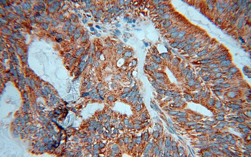 Immunohistochemical of paraffin-embedded human ovary tumor using Catalog No:110089(DNAJB11 antibody) at dilution of 1:100 (under 40x lens)