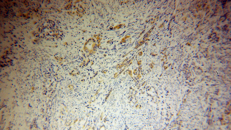 Immunohistochemical of paraffin-embedded human endometrial cancer using Catalog No:107610(STOML2 antibody) at dilution of 1:100 (under 10x lens)
