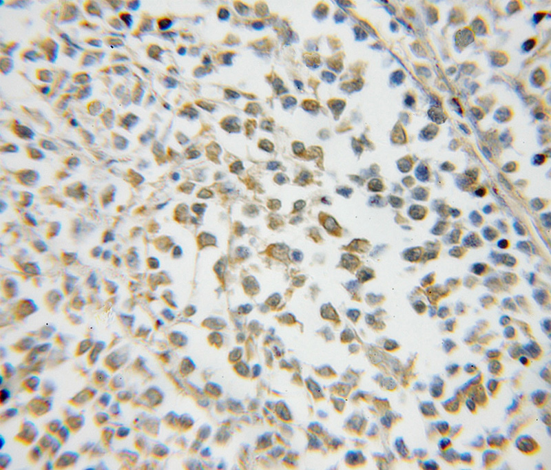 Immunohistochemical of paraffin-embedded human lymphoma using Catalog No:113452(NXF2 antibody) at dilution of 1:50 (under 10x lens)