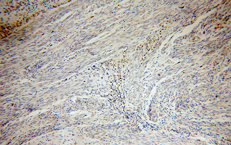 Immunohistochemical of paraffin-embedded human endometrial cancer using Catalog No:113553(P53 antibody) at dilution of 1:100 (under 10x lens)