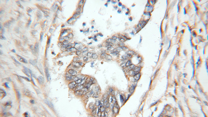 Immunohistochemical of paraffin-embedded human pancreas cancer using Catalog No:111242(GTPBP2 antibody) at dilution of 1:50 (under 10x lens)