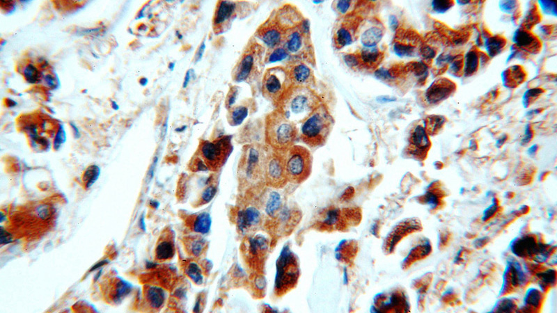 Immunohistochemical of paraffin-embedded human breast cancer using Catalog No:116262(TPD52L2 antibody) at dilution of 1:50 (under 40x lens)